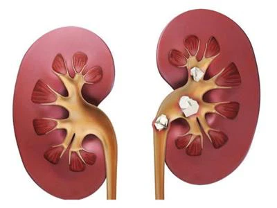 Anti-kidneystoneformation Anti-kidneystoneformation